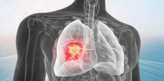 cancer de pulmon