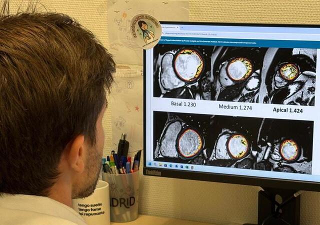 El Hospital Puerta de Hierro descarta enfermedad cardíaca en pacientes con hipertrabeculación del ventrículo izquierdo